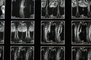 Japanese scientists achieve breakthrough in spinal cord treatment using stem cells